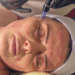 Microneedling
